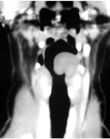 Figure 2. Computed tomography scan showing a well-defined homogeneous  mass in the left arythenoid