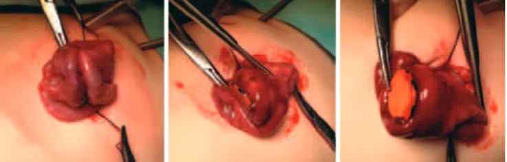 Figure 2. Intraoperative aspect showing one of magnets and the intestinal  perforation