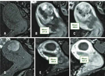 Figure 1. T2-weighted sagittal images demonstrating evaluation of the  endometrial signal by ROIs before (A) and after (B) embolization of uterine  arteries, with increased signal in (B)