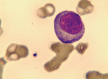 Figura 1. Plasmoblasto em sangue periférico Figura 2. Plasmoblasto