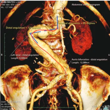 Figure 2. Tomographic control 1 year after surgery showing good positioning of  the endografts without endoleaks