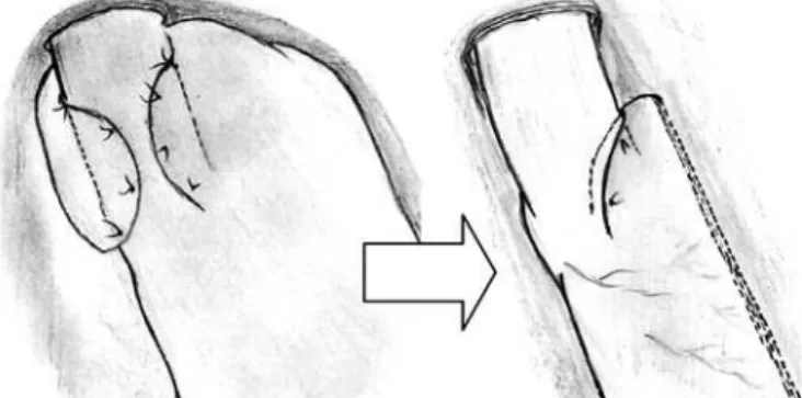 Figure 1. The traditional partial fundoplication (left) used in the surgical treatment  of gastroesophageal reflux disease and the cardioplication (right): a lower  position, a shorter plication and just 180 o  embracement spare most of the gastric  fundus