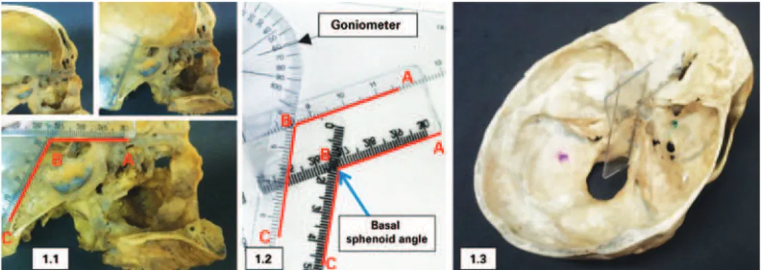 Figure 1. Method for measuring the basal sphenoid angle. (A) Medial sagittal plane of the cranium showing placement of the rulers in the anterior fossa (segment AB)  and the clivus (segment BC), forming, with the intersection, the basal sphenoid angle ABC 