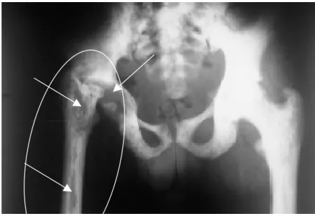 Figura 12: Raios-X da Bacia, com destaque para alteração óssea após um processo de inflamação do osso
