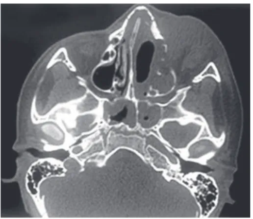 Figure 1. Computed tomography of the face sinuses. Signs of persistence of  lesion in edges of surgical sites toward left pterygopalatine fossa, remaining  antral cavities to the left and large orbital component also to the left, which  infiltrated pre and