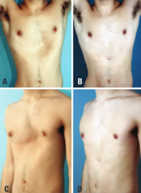 Figure 2. A 21 year-old patient with pectus excavatum presenting large  depression on left ribs