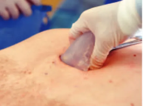 Figure 3. Illustration showing sculpted implant insertion made easier due to soft  silicone block flexibility, which enables inserting through relatively small incisions