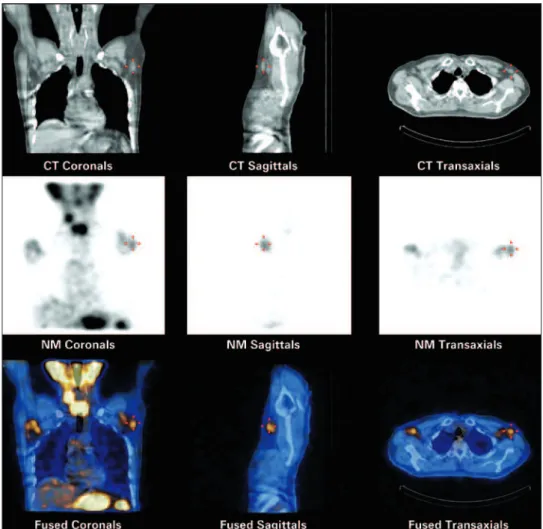 Figure 2. SPECT/CT 4 days after I-131 therapy. Beside radioiodine concentration in the surgical remnants of the thyroidectomy, significant uptake is detected in the  axillary lymph nodes, mainly in the left axillat axilla