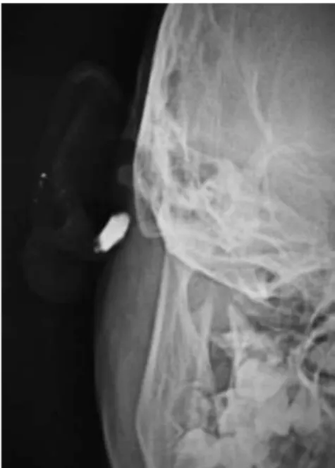 Figure 1. A pit (arrow) leading to a cystic cavity reaching the post-auricular  groove could be seen here, situated in the lower part of the medial surface of  right pinna just superior to the lobule