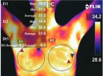 Figure 1. Thermal imaging of the breasts of one of the volunteers on day 9 of  the menstrual cycle