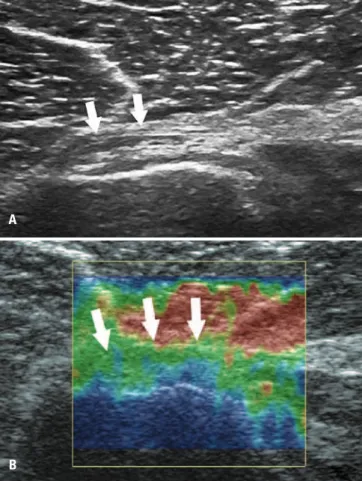 Figure 2. Ultrasound assessment of pectoralis major muscle tendon with  signs of tendinous injury