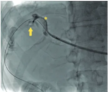 Figure 1. Radioscopic imaging by the flexible ureteroscopy