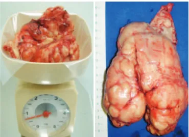 Figure 1. Computerized tomography scan showing urinary obstruction  (hydronephrosis) and a large pelvic mass representing the prostate