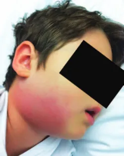 Figure 1. Cervical lymphadenitis with adjacent cellulitis initially seen in the  described Kawasaki disease patient