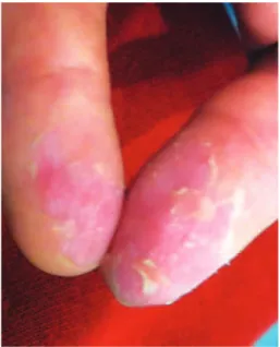 Figure 4. Lamellar desquamation of the fingers