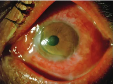 Figure 1. Significant corneal thinning