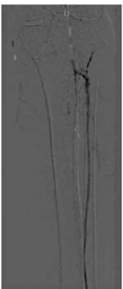 Figure 1. Carbon dioxide arteriography. Patent popliteal and fibular arteries,  occlusion in the mid-third of the anterior tibial artery