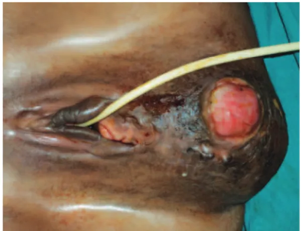 Figure 1. Pre-operative appearance. Large mass located in perineal and vulvar  region