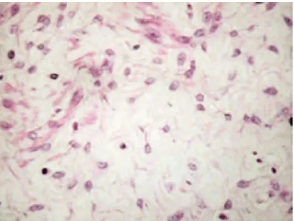 Figure 3. Microscopic appearance of the tumor. Vessels of medium size and  thickened wall, involved by stromal cell layer of myxoid apperance