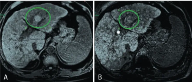 Figure 2. MRI with liver-specific contrast in a chronic liver disease patient  showing lesion with characteristics of dysplastic nodule on the left lobe