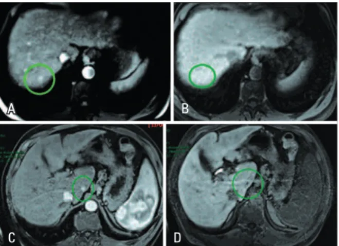 Figure 3. MRIs with liver-specific contrast medium of two chronic liver disease  patients