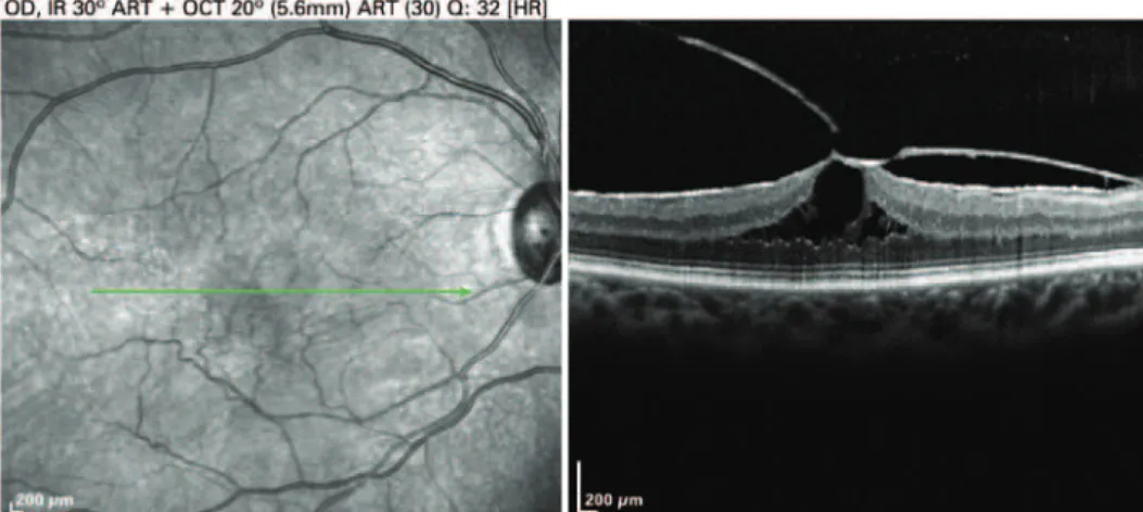 Figure 1. Camel-Hump Sign. Optical coherence tomography of the right eye showing centripetal traction area in  macule region suggesting appearance of tractional retinal detachment