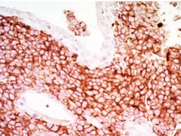 Figure 1. Field with the presence of multiple mitoses, salt-and-pepper nuclei