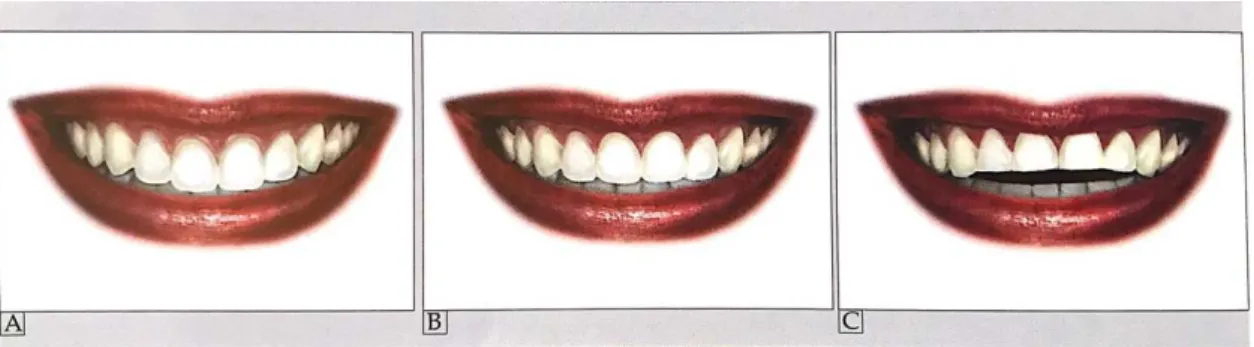 Figura 5 -  Desenhos esquemáticos que ilustram os tipos de curvatura incisal superior em relação ao lábio  inferior