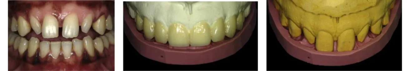 Figura 7 -  Apresentação do enceramento diagnóstico e guia de preparo em um caso com diastemas,  dentes com morfologia e inclinação alteradas