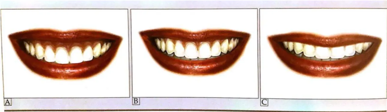 Figura 9 -  Desenho esquemático dos três tipos de sorriso. (Mondelli et al., 2018)   (A) sorriso alto; (B) sorriso médio; (C) sorriso baixo