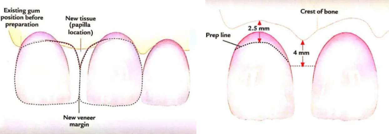 Figura 11 -  Distância entre o ponto de contacto e crista óssea para melhorar o preenchimento do tecido  gengival