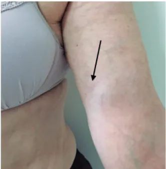 Figure 2. Final esthetic result three months after the procedure (arrow shows the  surgical scar site)