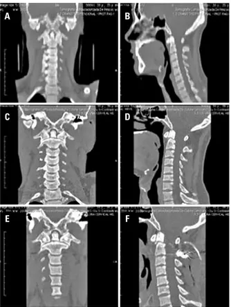 Figure 3. Odontoid fracture type II, conservative treatment failure. (A and B)   non-comminuted odontoid fracture without deviation in a 37 years old patient,   (C and D) computed tomography scan after eight weeks of conservative  treatment showing, (E and