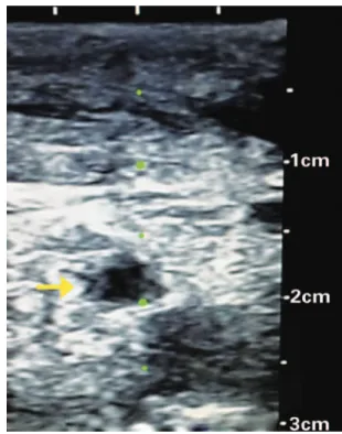 Figura 1. Corte transverso de vasos cervicais demonstrando estenose de veia  jugular interna esquerda (seta) secundária a diversas punções venosas prévias