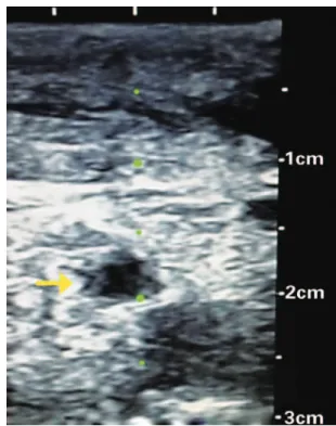 Figure 1. Cross-sectional image of cervical veins showing stenosis of internal  left jugular vein (arrow) secondary to previous venous punctures
