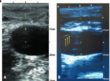 Figure 4. The needle guide (arrow) fixates an insertion angle of the needle in  relation to ultrasound transducer