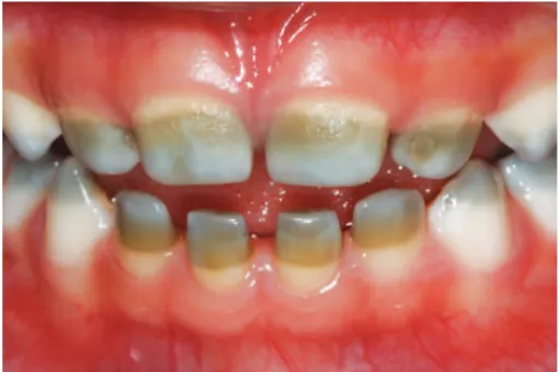 Figure 1. Frontal view of the dental arches showing greenish coloration in the incisal and middle thirds of  deciduous incisors and canines as a consequence of neonatal cholestasis