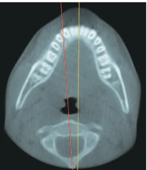 Figura 3. Reconstrução coronal das vértebras cervicais. Setas vermelhas  indicando a inclinação laterolateral da segunda vértebra