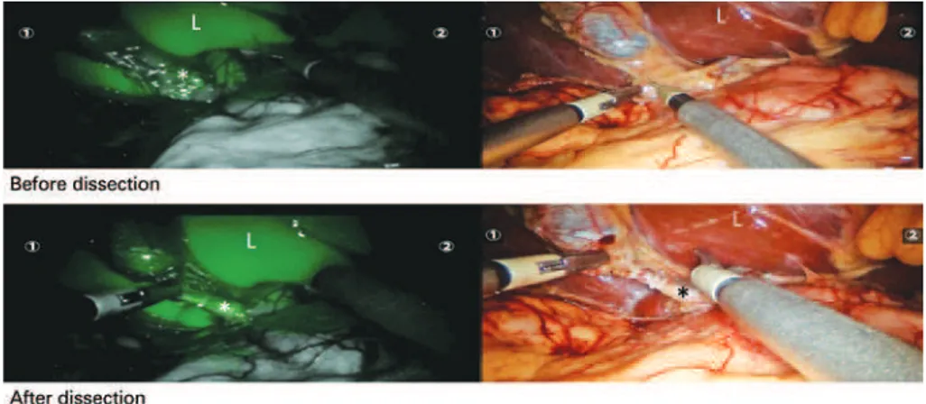 Figure 1. Biliary anatomy revealed by intraoperative near-infrared fluorescent imaging during a single-port robotic cholecystectomy in a 42-year-old female patient