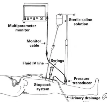 Figure 2. Intra-abdominal pressure measurement using the pressure transducer  technique and a three-way stopcock system