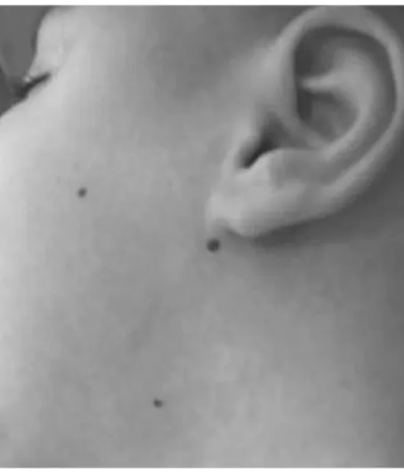Figure 1. Botulinum toxin application points in salivary glands. Parotid gland (two  points) and submandibular glands (one point)