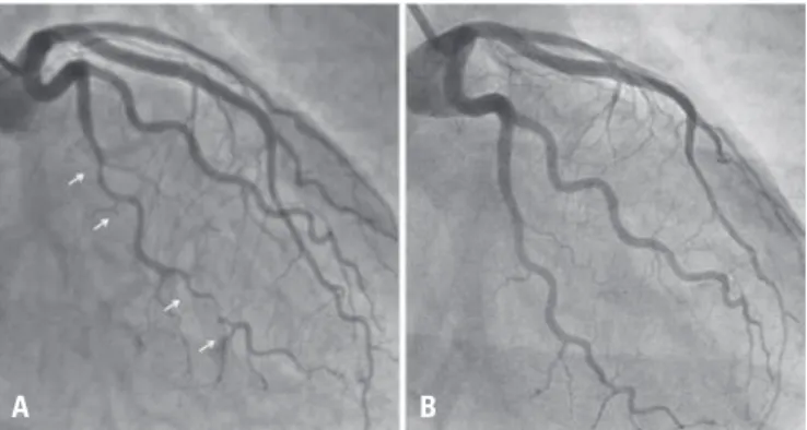 Figure 1. Coronary angiography (A) during hospitalization and (B) 6 months