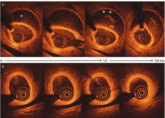 Figure 2. Optical coherence tomography from proximal (0mm) to distal (5mm) in the OM at (A) baseline and (B)  at 6-month follow-up; the images represent the exact  same locations in the artery with the spontaneous coronary dissection (A) and healing (B)