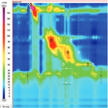 Figure 4. Absent contractility in a patient with scleroderma