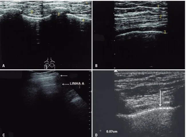 Figure 1. Sonographic anatomy. (A) Chest wall sonogram (7 MHz linear probe). (1) Observe the different tissue planes displayed: skin and subcutaneous tissue, (2)  ribs (transverse plane), (3) intercostal muscles, (4) pleural line