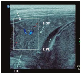 Figure 3. B lines appear as comet-tail artifacts (arrows) perpendicular to the  pleural surface