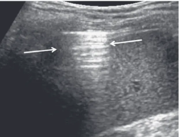 Figure 6. Z lines are common artifacts seen in more than 80% of the population. 