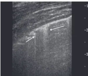 Figure 9. Coalescent B2 lines (ground glass pattern)