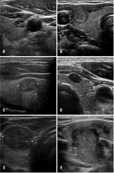 Figure 1. Examples of thyroid nodules submitted to cytological examination. (A)  Nodule classified as TI-RADS 2; (B) TI-RADS 3; (C) TI-RADS 4A; (D) TI-RADS 4B; 