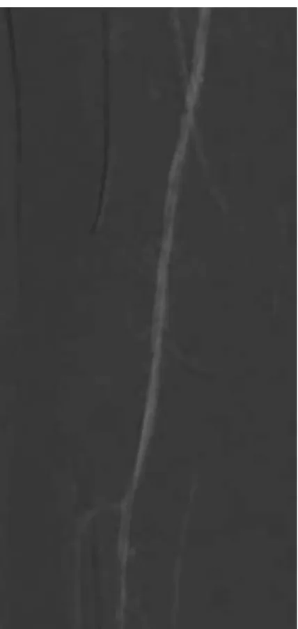 Figure 1 . Example of a carbon dioxide arteriography